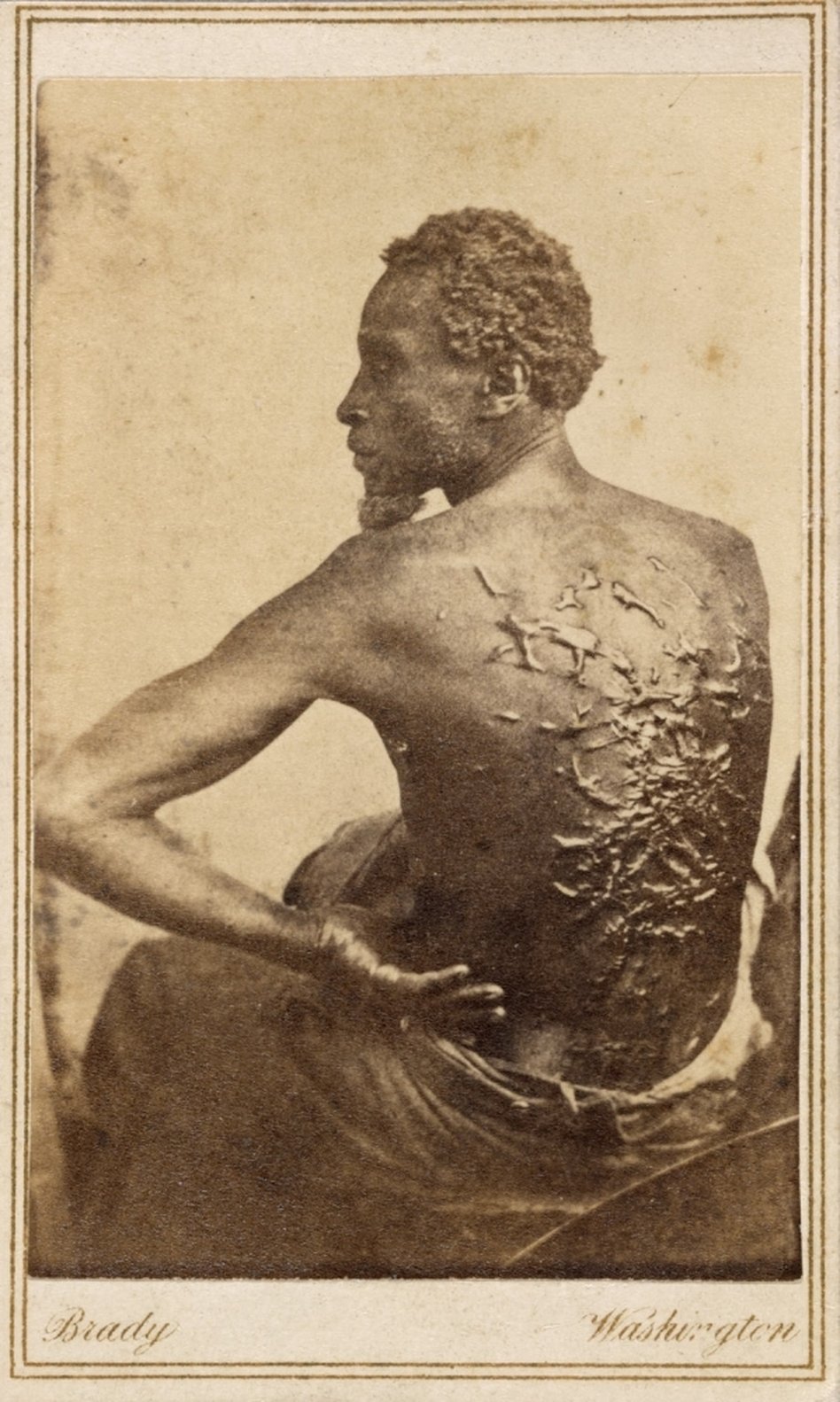 Mathew Brady photo of Gordon, a whipped and scarred slave