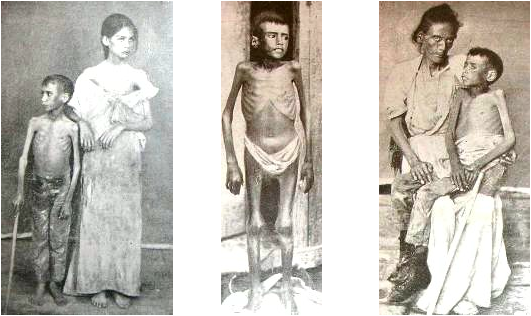 3 photos of emaciated people