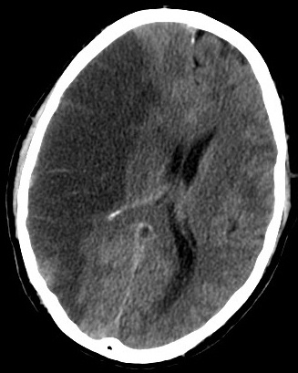 The darkened half of the brain (left side of the image) shows a cerebral ischemia.